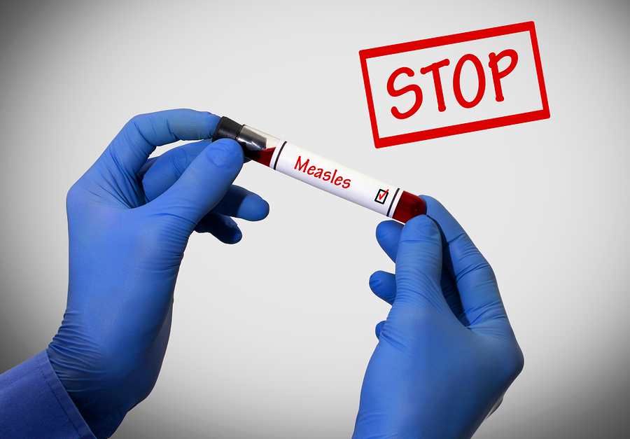 What is measles? Measles is a viral infection that begins with a fever that lasts for several days, followed by a cough, runny nose, and conjunctivitis (pink eye).  The rash […]